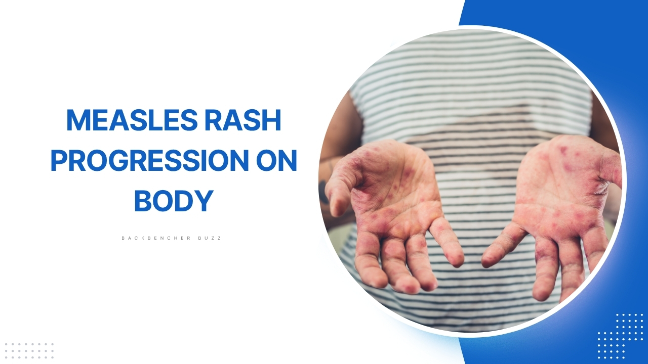 Close-up of measles rash on palms showing red blotchy skin symptoms